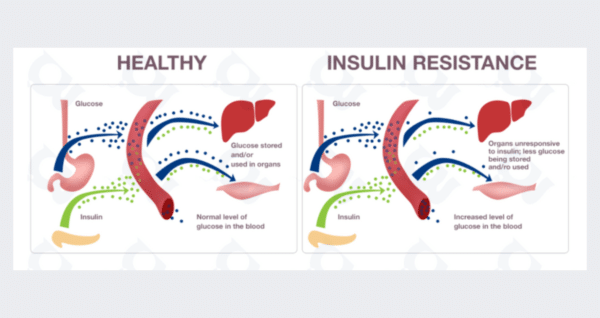 insulin resistance visual